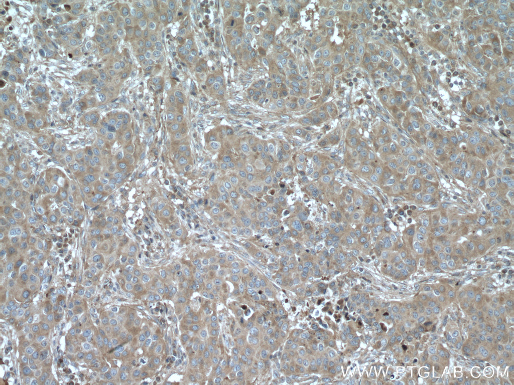 IHC staining of human breast cancer using 26855-1-AP