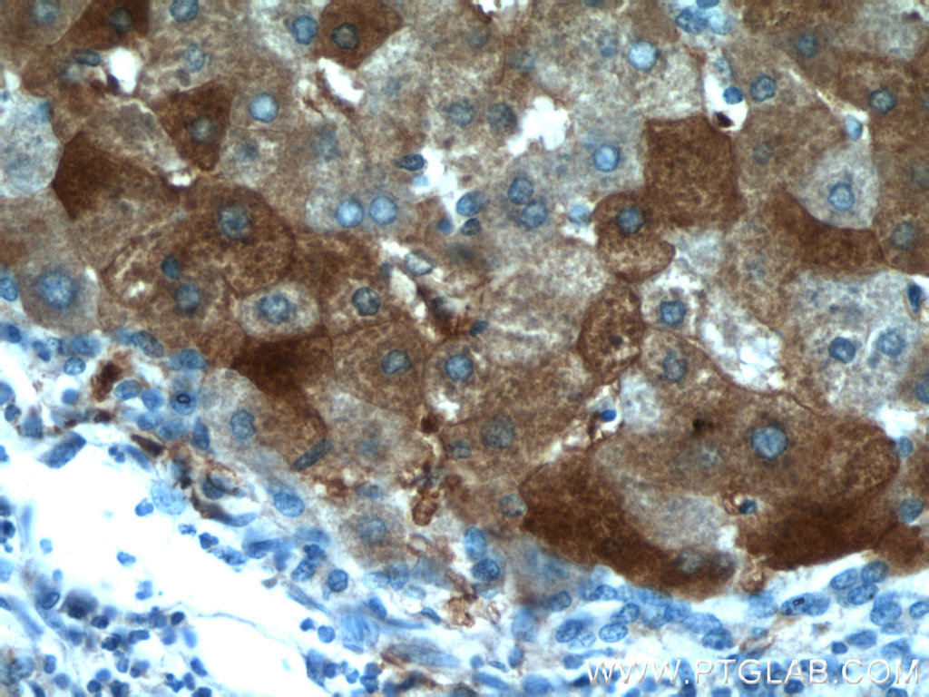 IHC staining of human hepatocirrhosis using 20331-1-AP