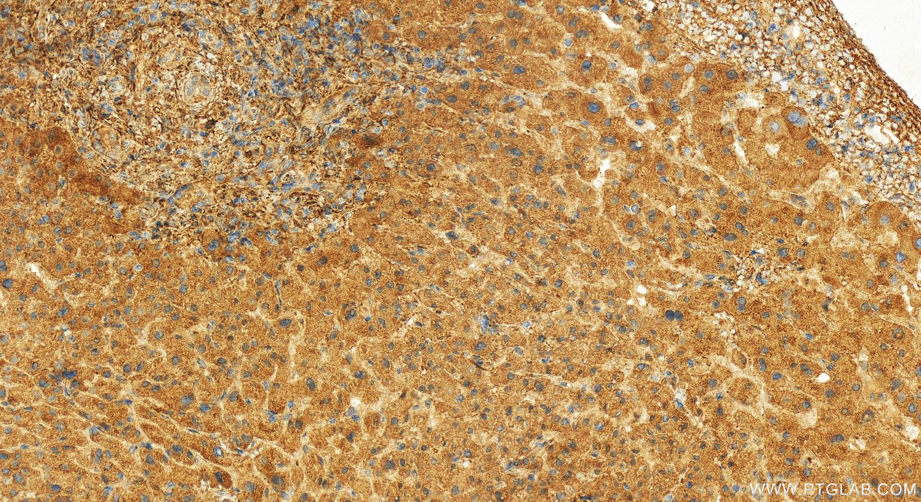 IHC staining of human intrahepatic cholangiocarcinoma using 13056-1-AP