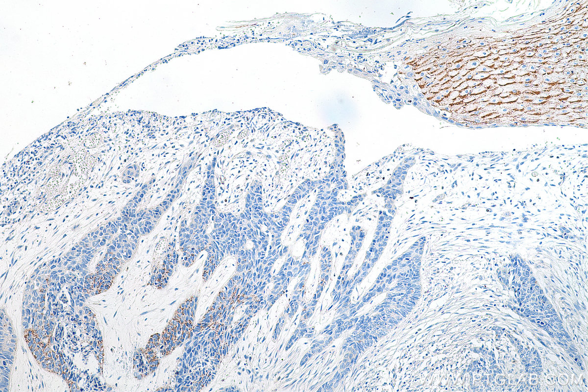 IHC staining of human skin cancer using 17361-1-AP