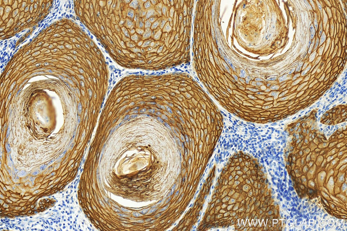 IHC staining of human skin cancer using 82094-1-RR