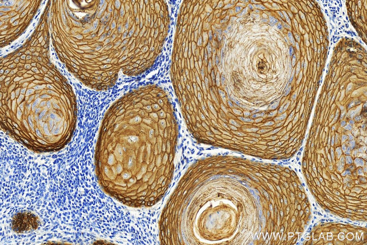 IHC staining of human skin cancer using 82094-1-RR