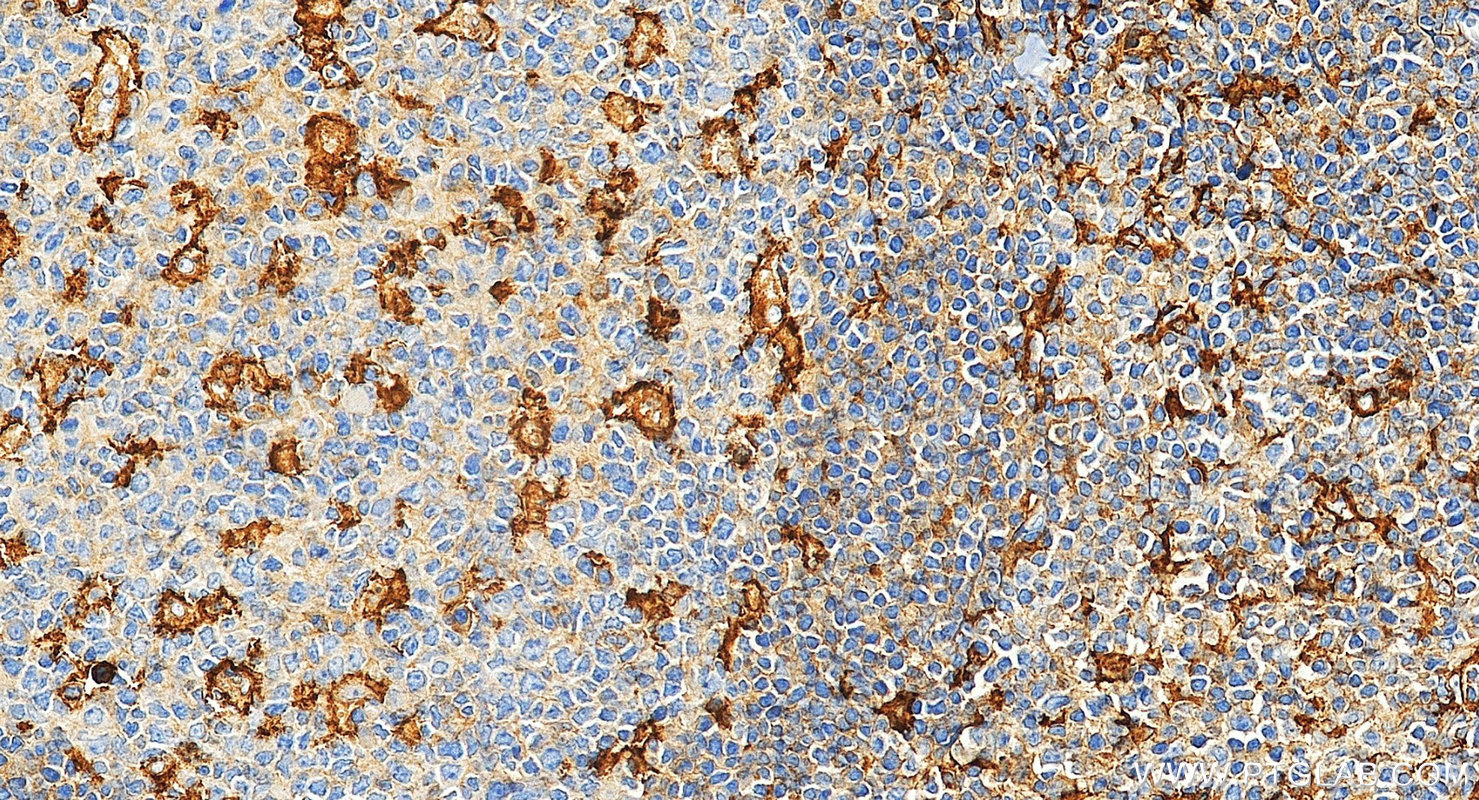 IHC staining of human tonsillitis using 32754-1-AP