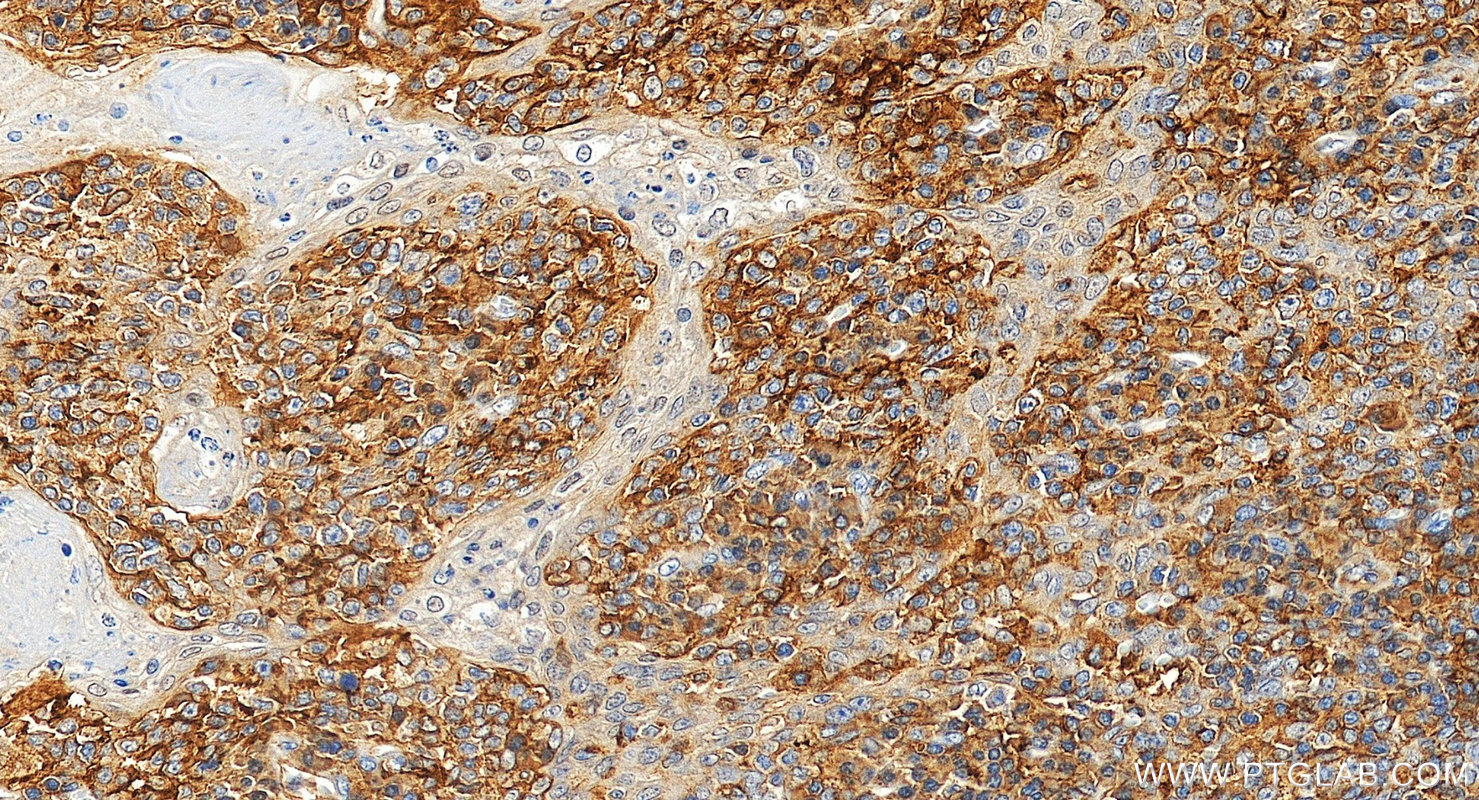 IHC staining of human tonsillitis using 32754-1-AP