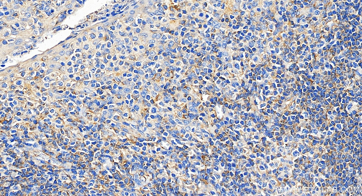 IHC staining of human tonsillitis using 87173-1-RR
