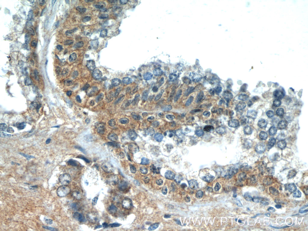 IHC staining of human prostate hyperplasia using 15677-1-AP