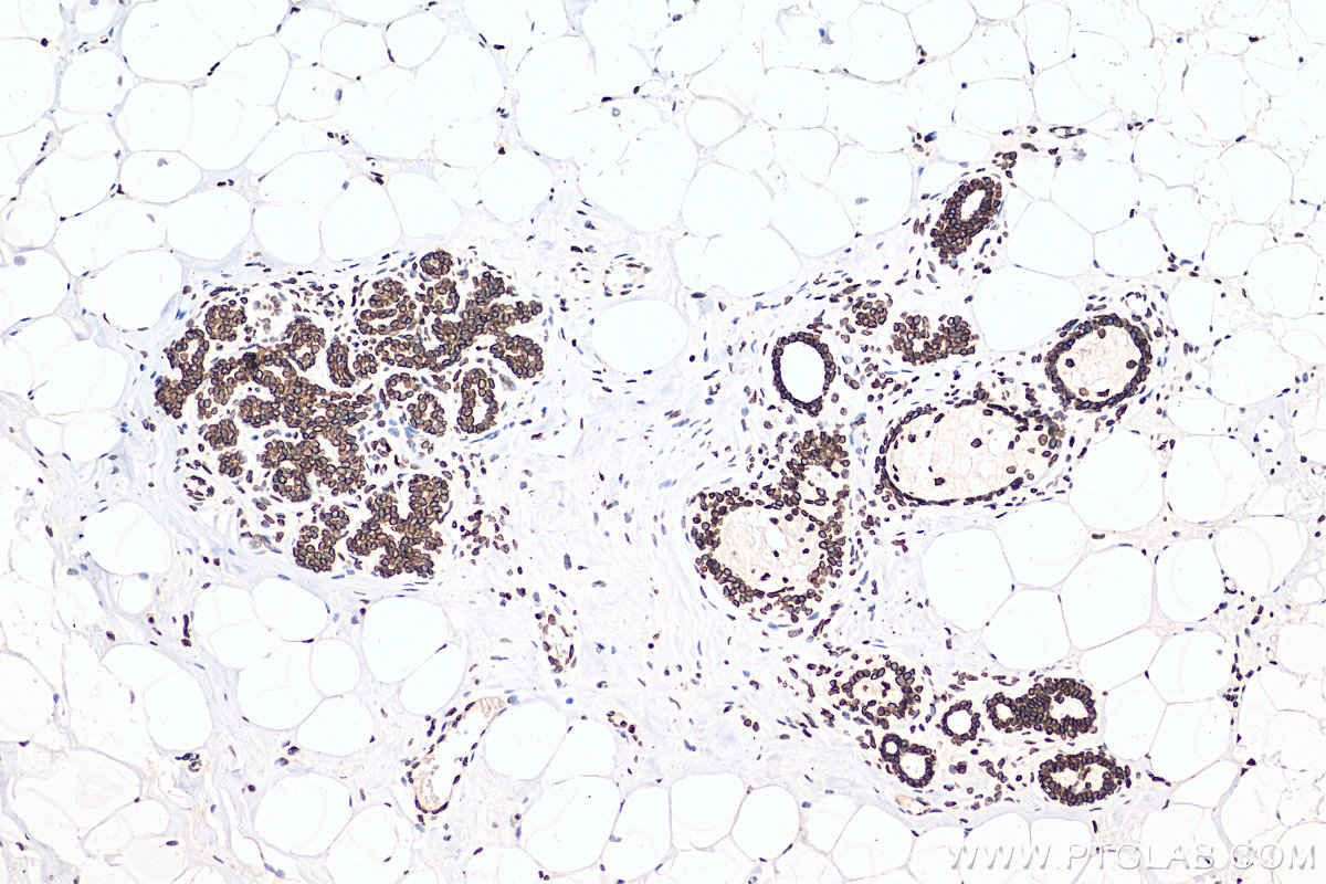 IHC staining of human breast cancer using 80906-1-RR