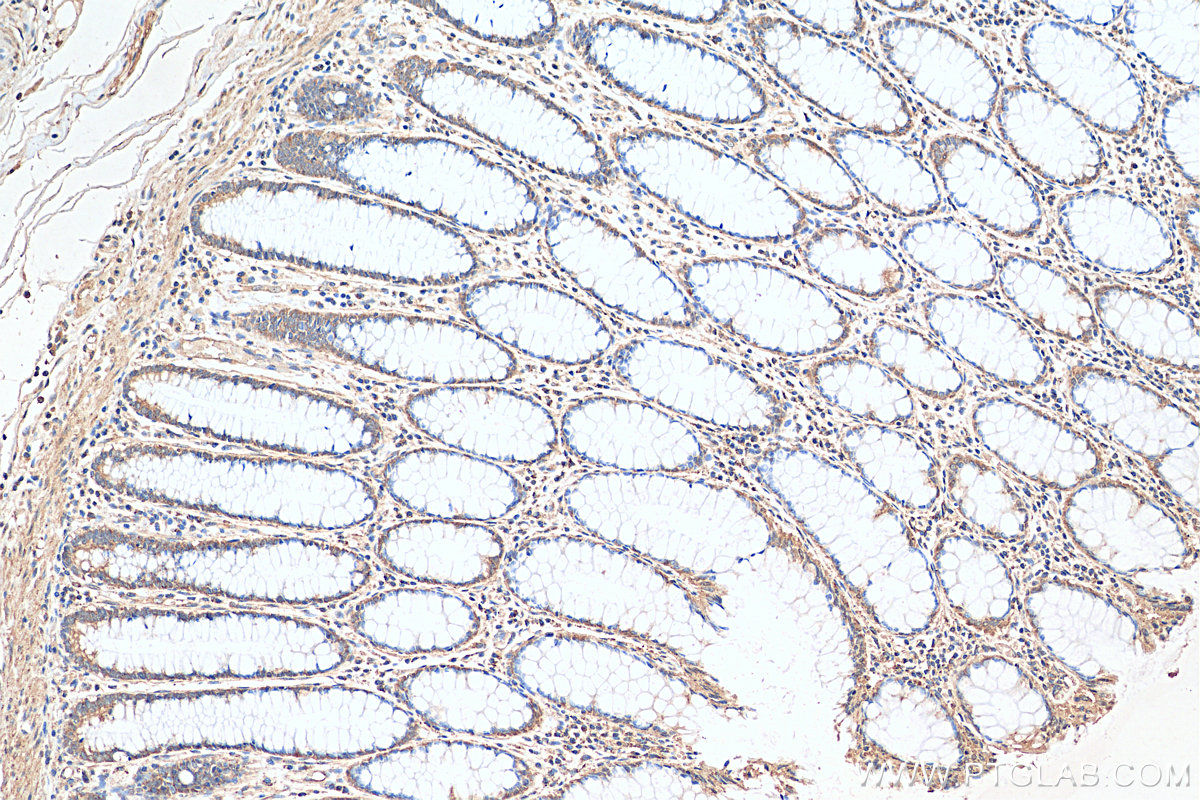 IHC staining of human colon cancer using 16178-1-AP
