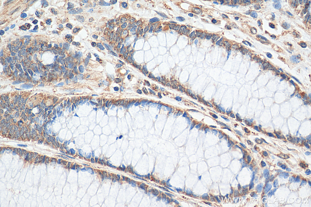 IHC staining of human colon cancer using 16178-1-AP