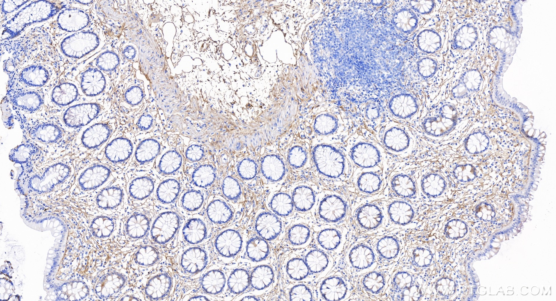 IHC staining of human colon using 85343-1-RR (same clone as 85343-1-PBS)