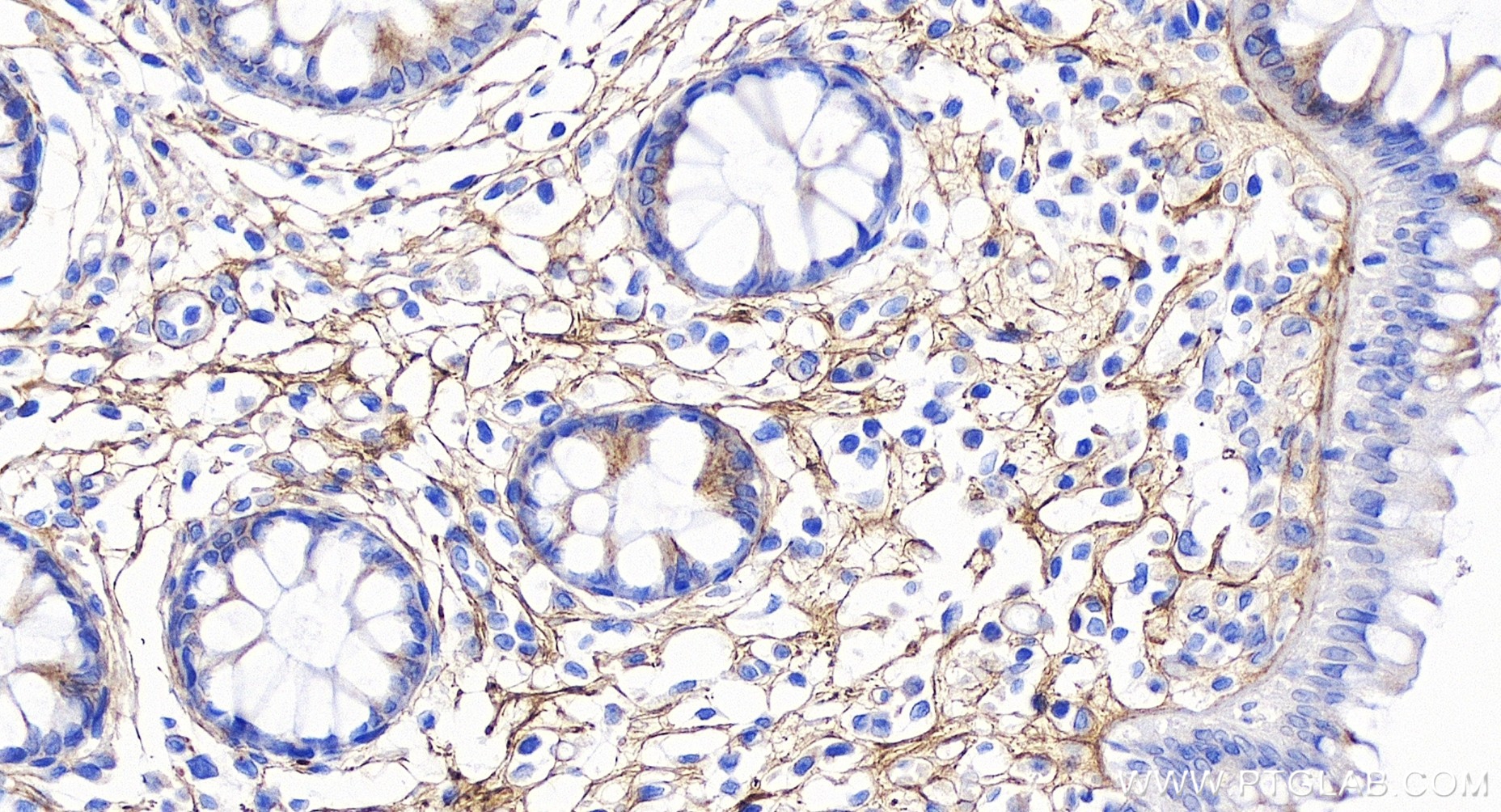 IHC staining of human colon using 85343-1-RR (same clone as 85343-1-PBS)