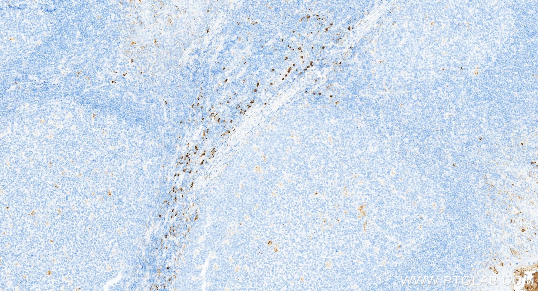 IHC staining of human tonsillitis using 84140-1-RR (same clone as 84140-1-PBS)