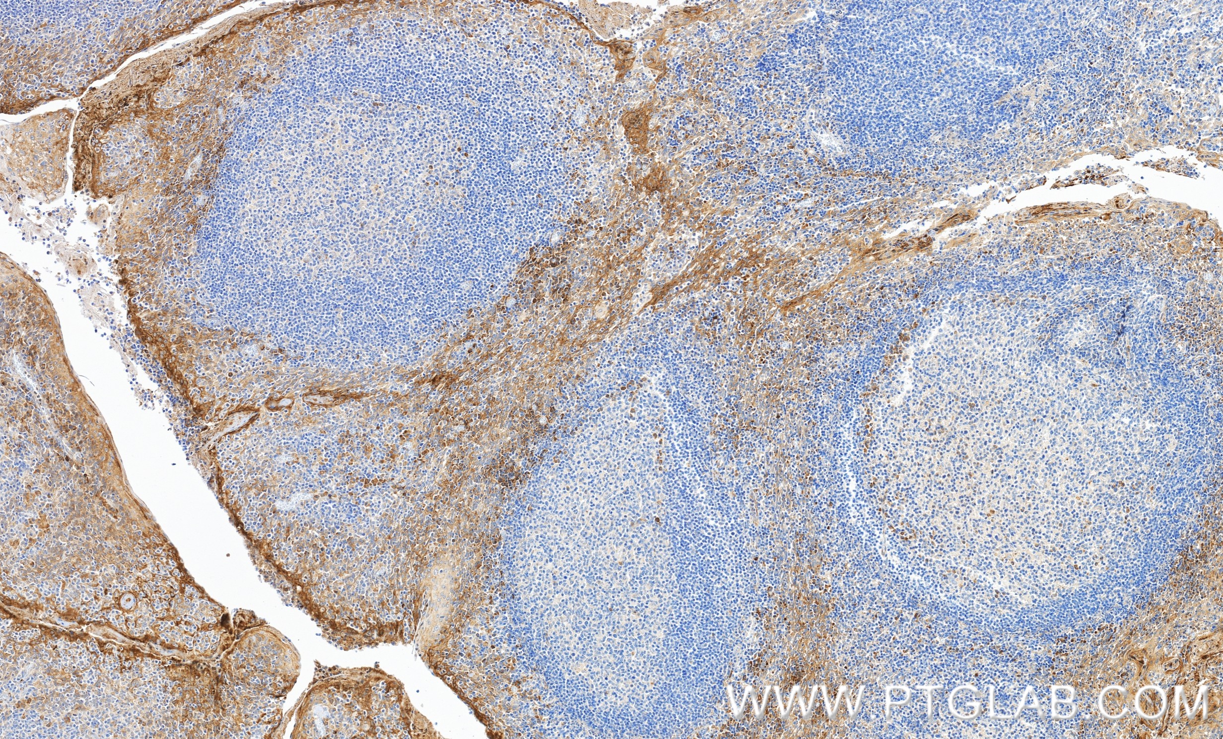 IHC staining of human tonsillitis using 98756-2-RR IHC staining of human tonsillitis using 98756-2-RR