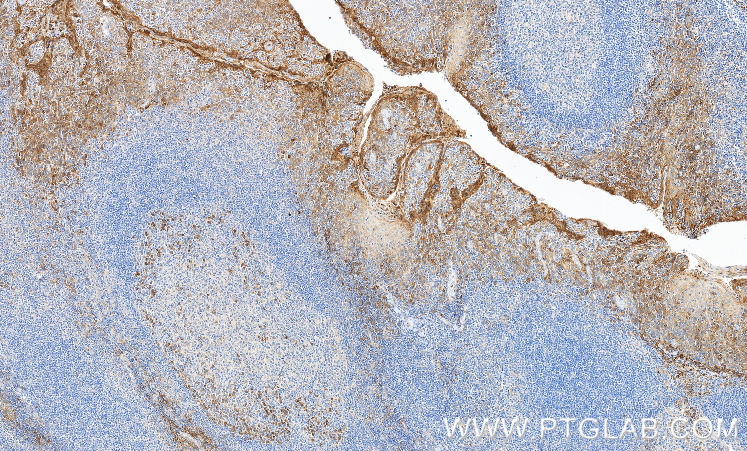 IHC staining of human tonsillitis using 98756-2-RR IHC staining of human tonsillitis using 98756-2-RR