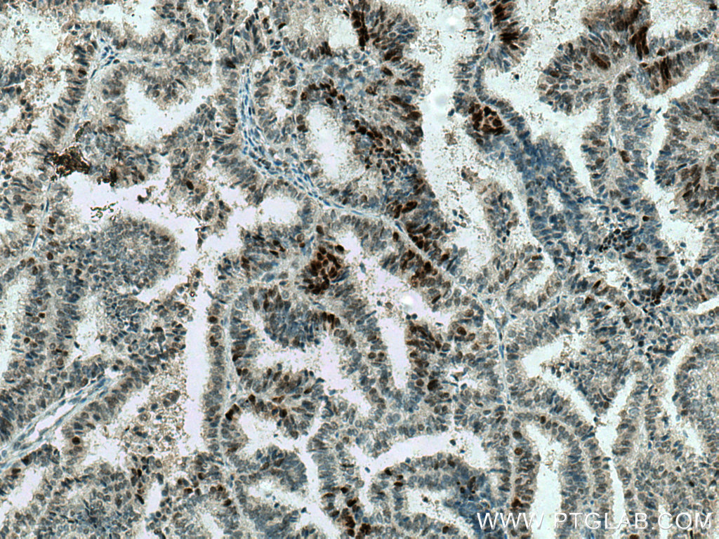 IHC staining of human ovary tumor using 12683-1-AP