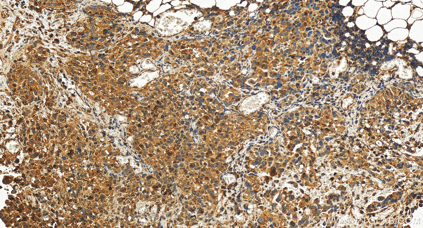 IHC staining of human ovary cancer using 29663-1-AP