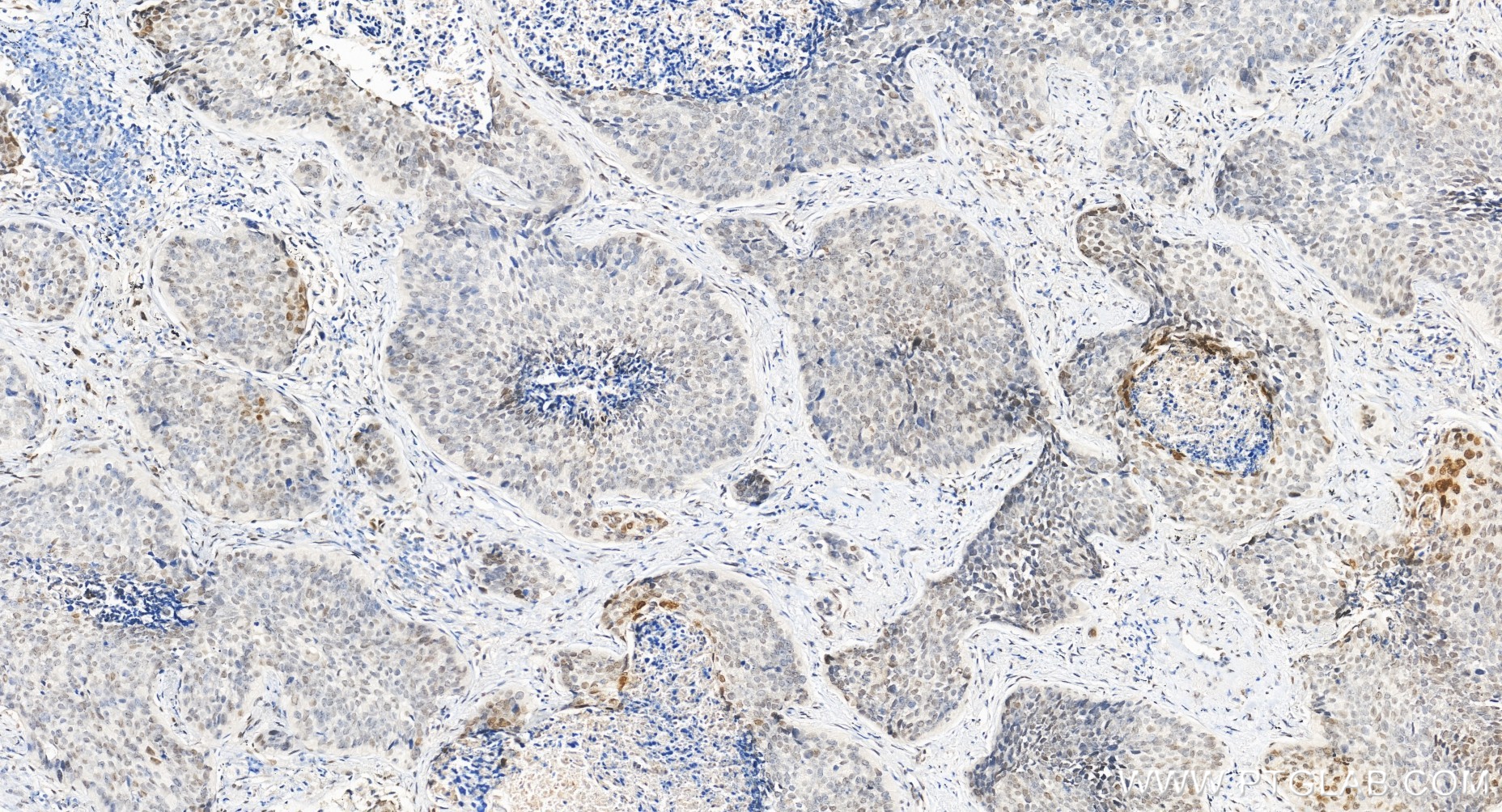 Immunohistochemical analysis of paraffin-embedded human lung cancer tissue slide using 85186-3-RR (MAFF antibody) at dilution of 1:200 (under 20x lens). Heat mediated antigen retrieval with Tris-EDTA buffer (pH 9.0). IHC staining of human lung cancer using 85186-3-RR