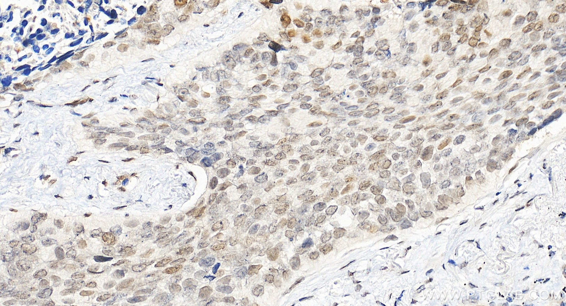Immunohistochemical analysis of paraffin-embedded human lung cancer tissue slide using 85186-3-RR (MAFF antibody) at dilution of 1:200 (under 20x lens). Heat mediated antigen retrieval with Tris-EDTA buffer (pH 9.0). IHC staining of human lung cancer using 85186-3-RR