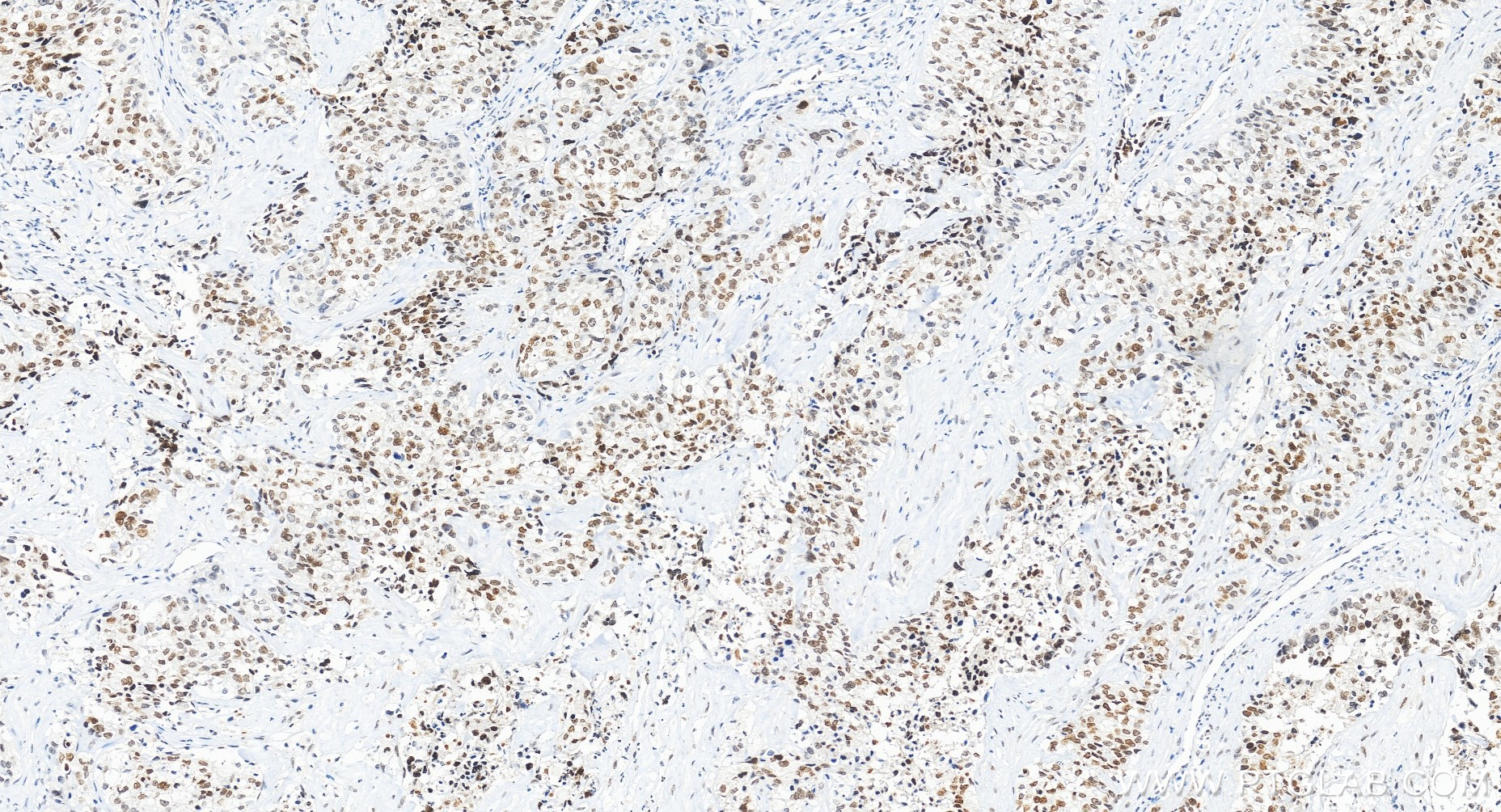 Immunohistochemical analysis of paraffin-embedded human ovary cancer tissue slide using 85186-3-RR (MAFF antibody) at dilution of 1:200 (under 20x lens). Heat mediated antigen retrieval with Tris-EDTA buffer (pH 9.0). IHC staining of human ovary cancer using 85186-3-RR