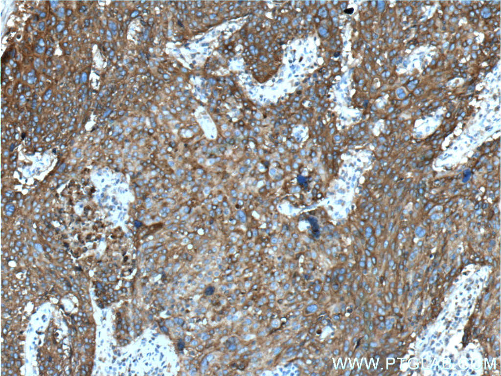 IHC staining of human lung cancer using 60054-1-Ig