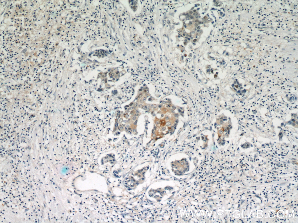 IHC staining of human breast cancer using 55109-1-AP