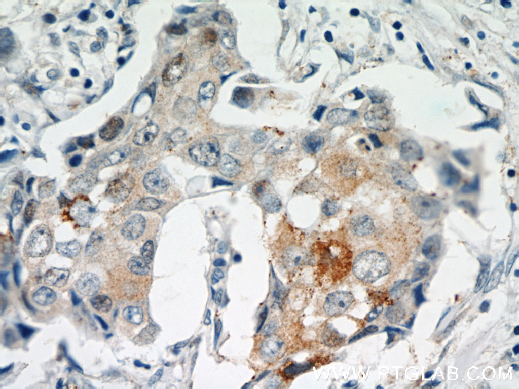 IHC staining of human breast cancer using 55109-1-AP