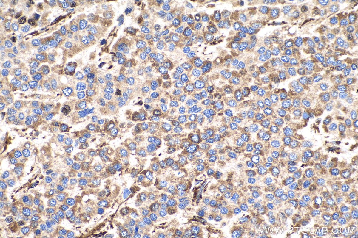 IHC staining of human liver cancer using 10280-1-AP