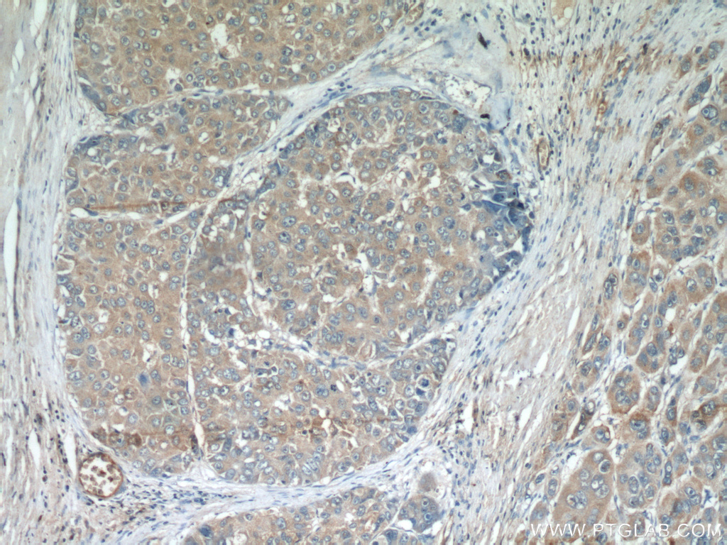 IHC staining of human liver cancer using 21491-1-AP