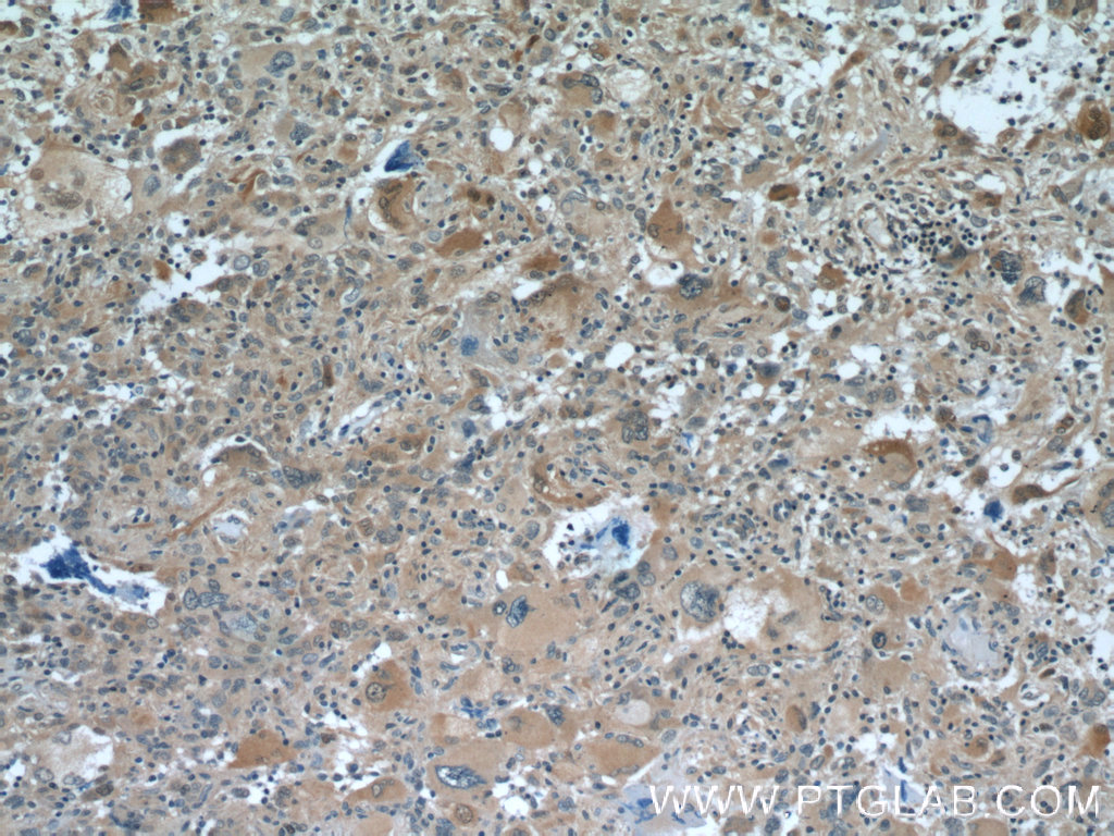 IHC staining of human gliomas using 11539-1-AP