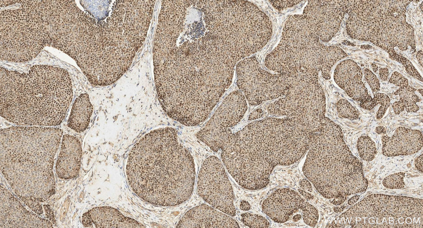 IHC staining of human breast cancer using 24105-1-AP