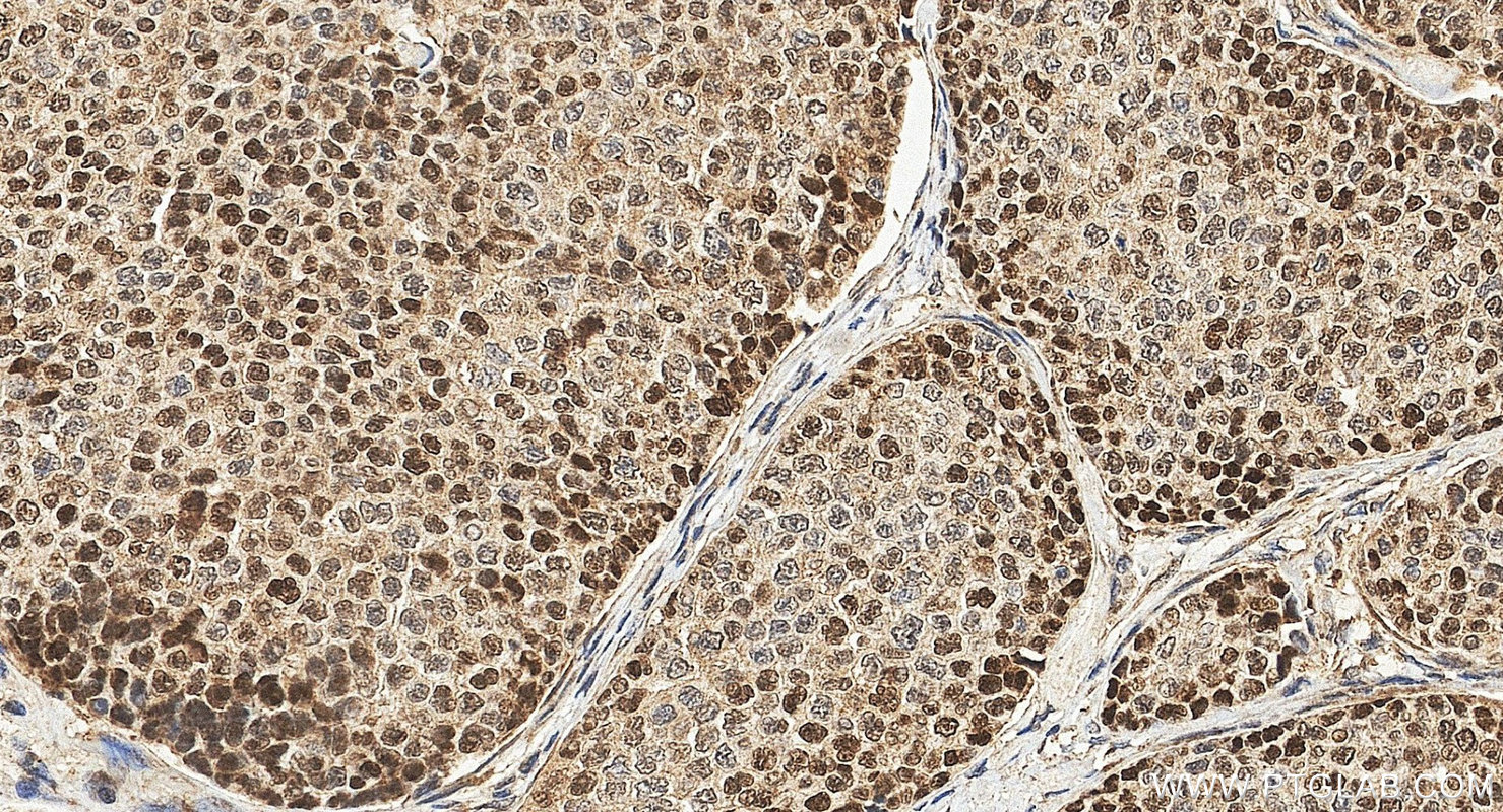 IHC staining of human breast cancer using 24105-1-AP