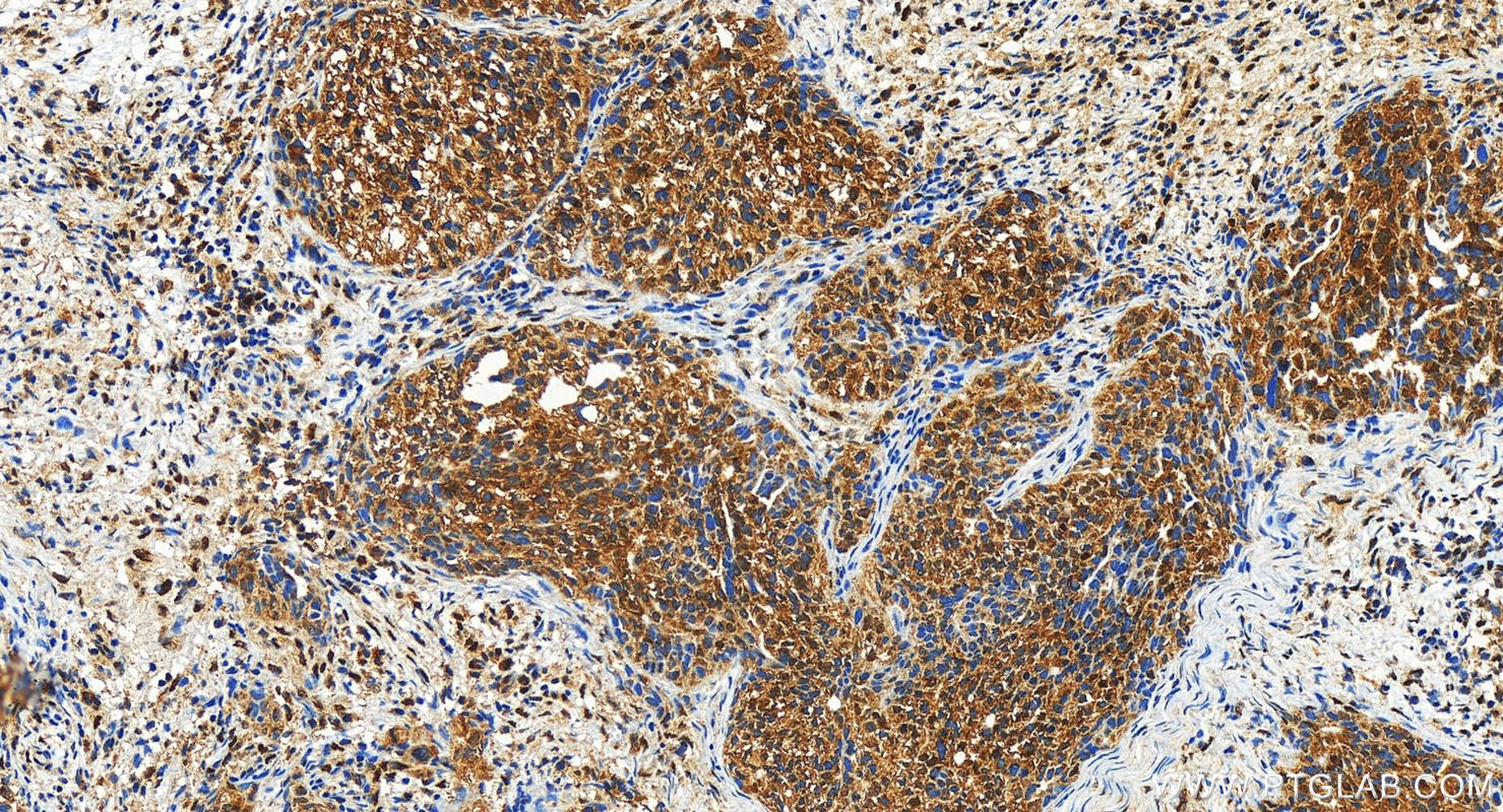 IHC staining of human ovary cancer using 22615-1-AP
