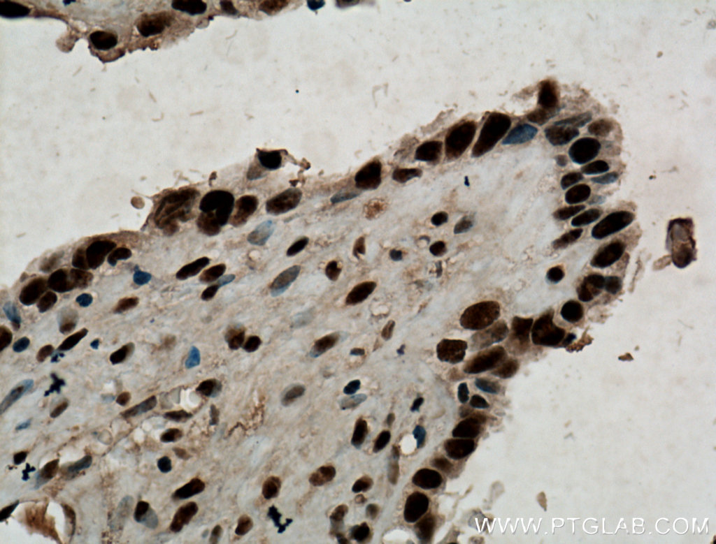 IHC staining of human ovary tumor using 12347-1-AP