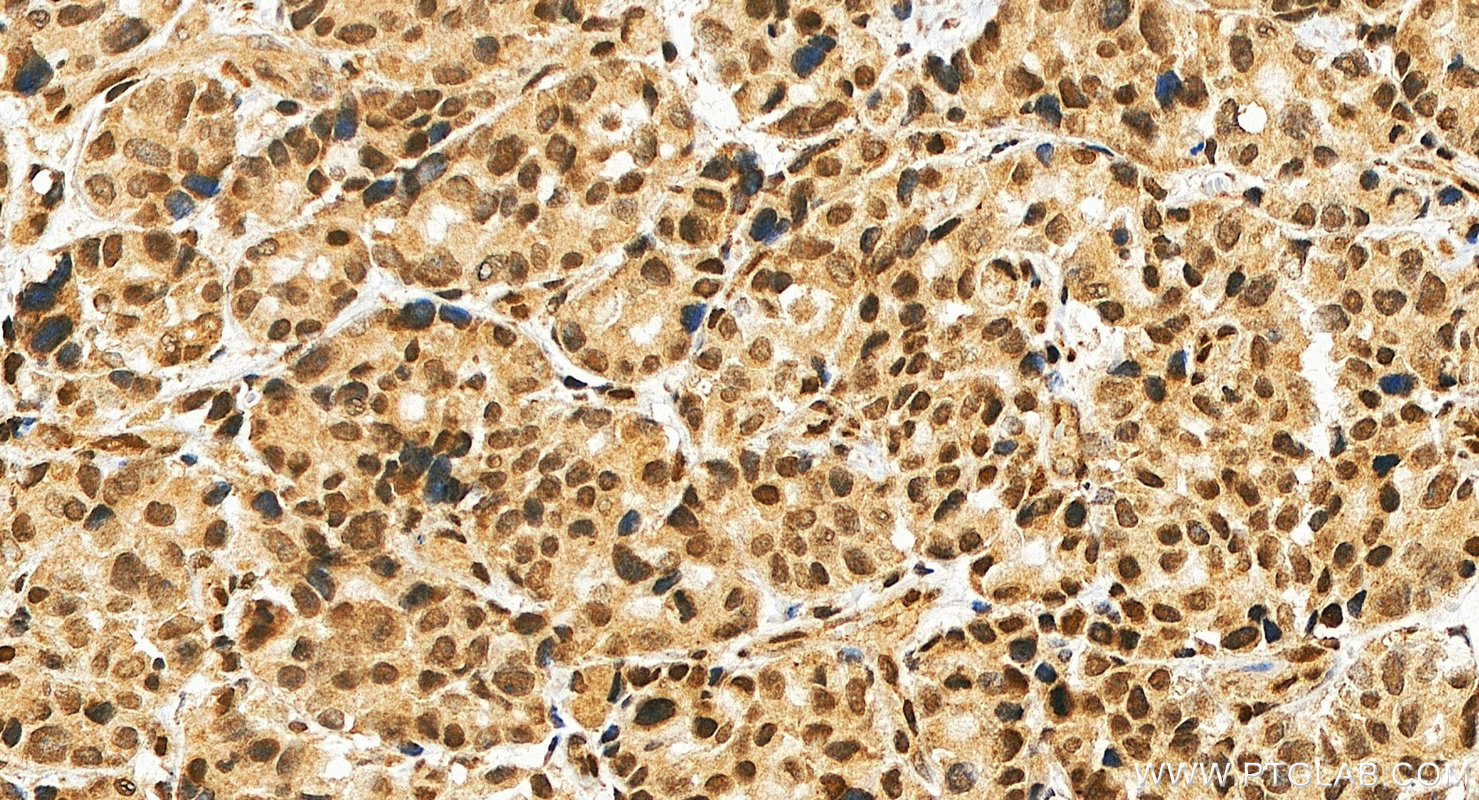 IHC staining of human stomach cancer using 23263-1-AP IHC staining of human stomach cancer using 23263-1-AP