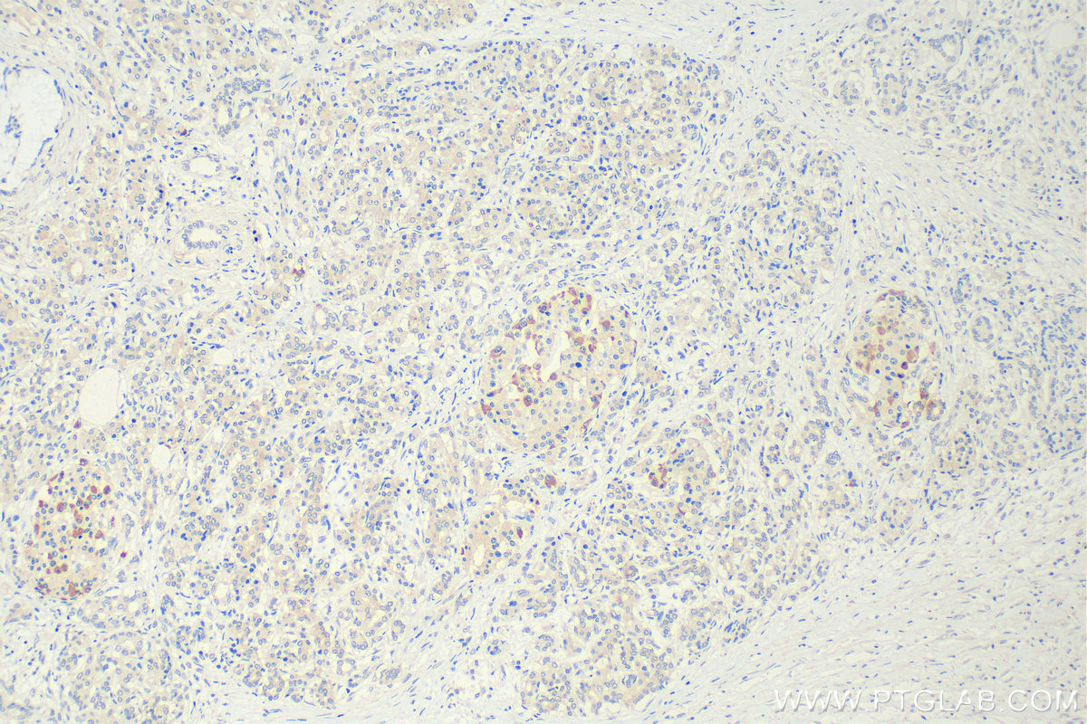 IHC staining of human pancreas cancer using 68471-1-Ig