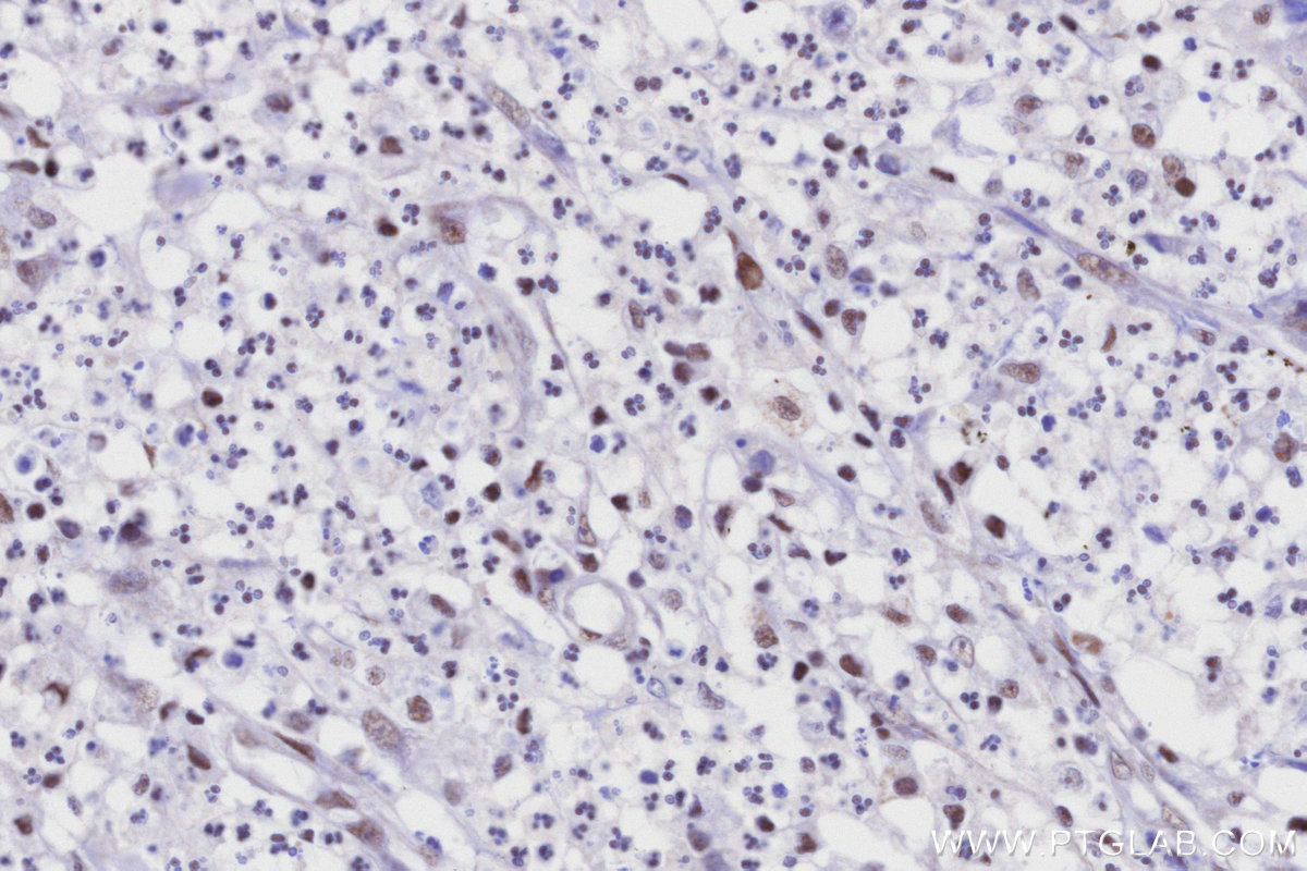 IHC staining of human colon cancer using 86695-1-RR (same clone as 86695-1-PBS) IHC staining of human colon cancer using 86695-1-RR (same clone as 86695-1-PBS)