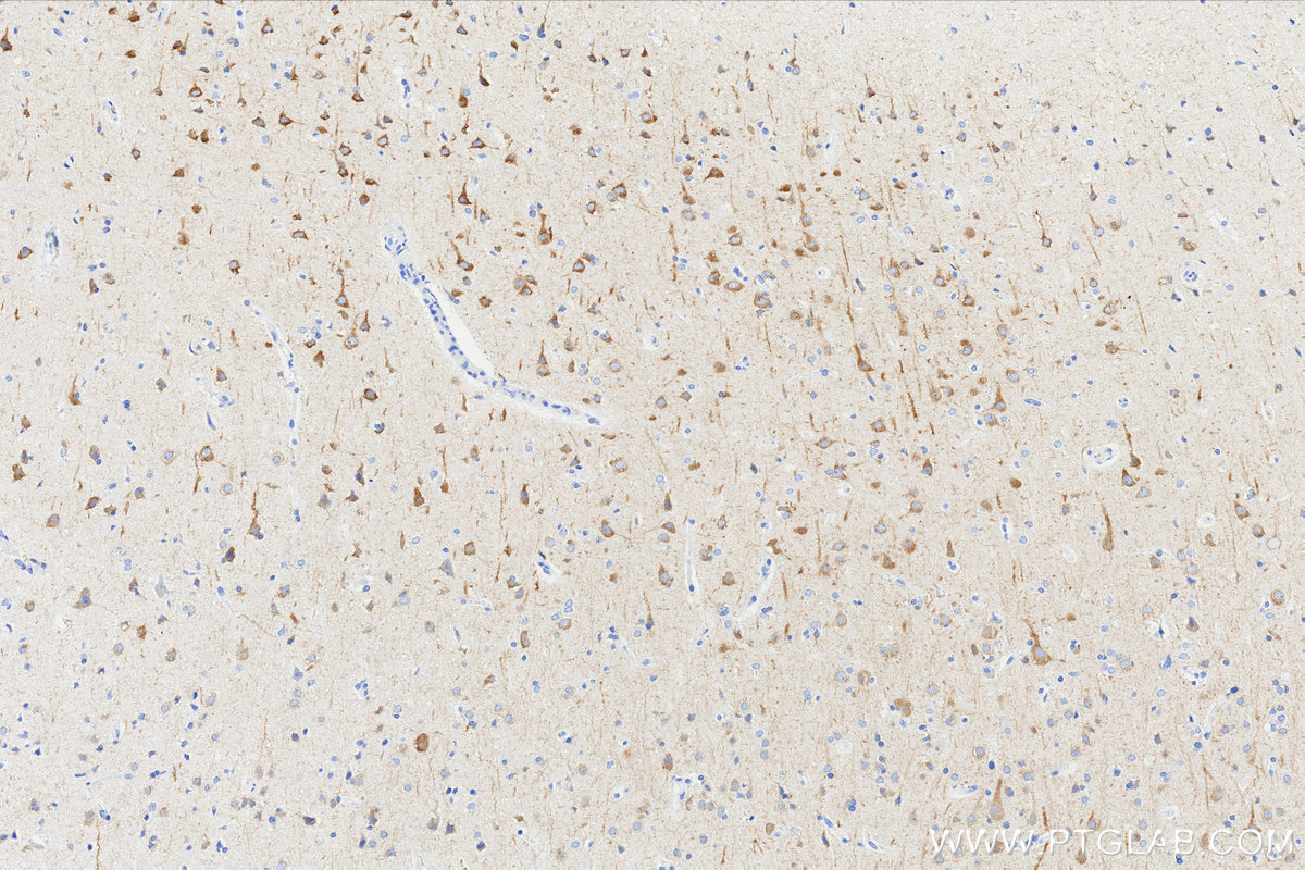 IHC staining of Human brain cancer(Astrocitoma) using 87623-1-RR (same clone as 87623-1-PBS) IHC staining of Human brain cancer(Astrocitoma) using 87623-1-RR (same clone as 87623-1-PBS)