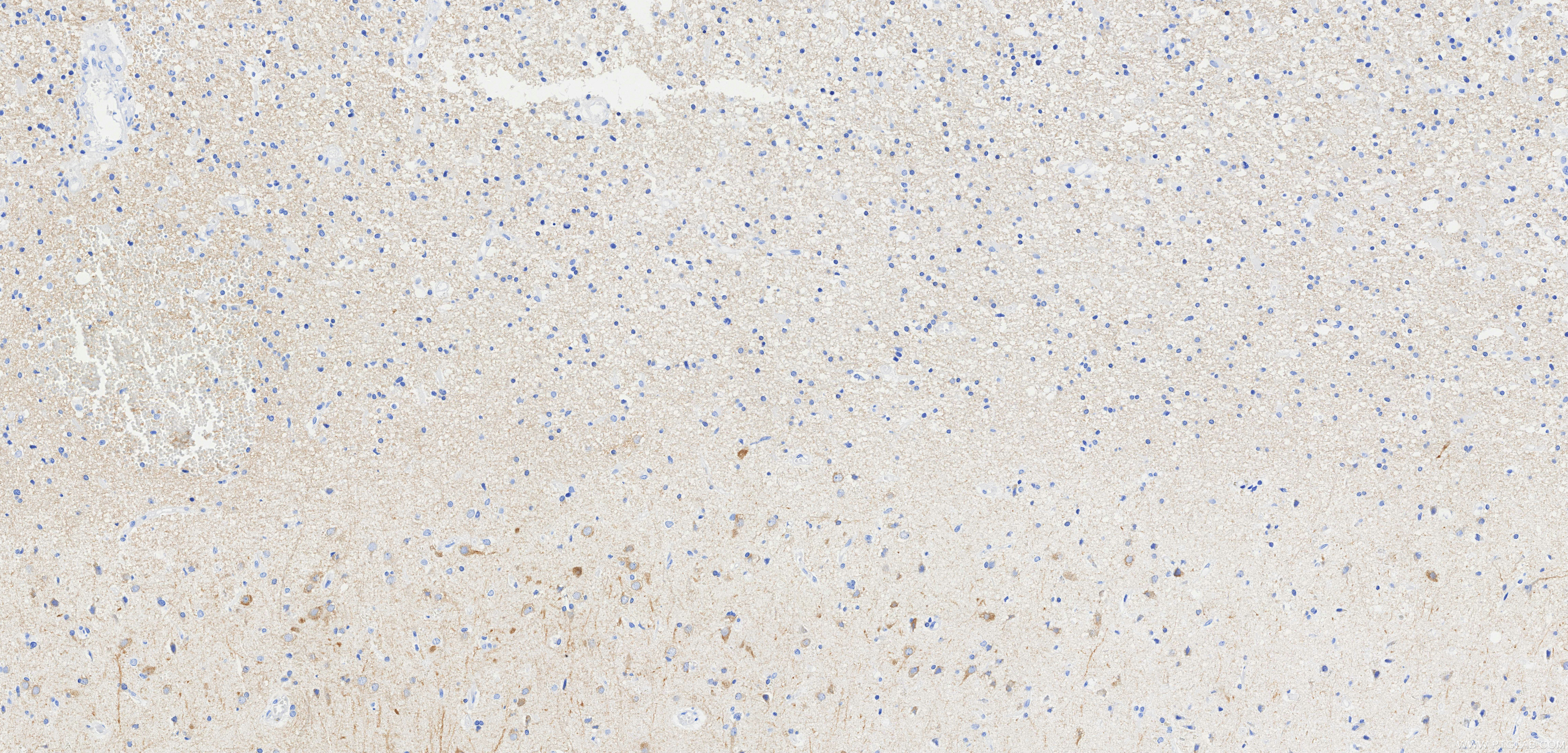 IHC staining of Human brain cancer(Astrocitoma) using 87623-1-RR (same clone as 87623-1-PBS) IHC staining of Human brain cancer(Astrocitoma) using 87623-1-RR (same clone as 87623-1-PBS)