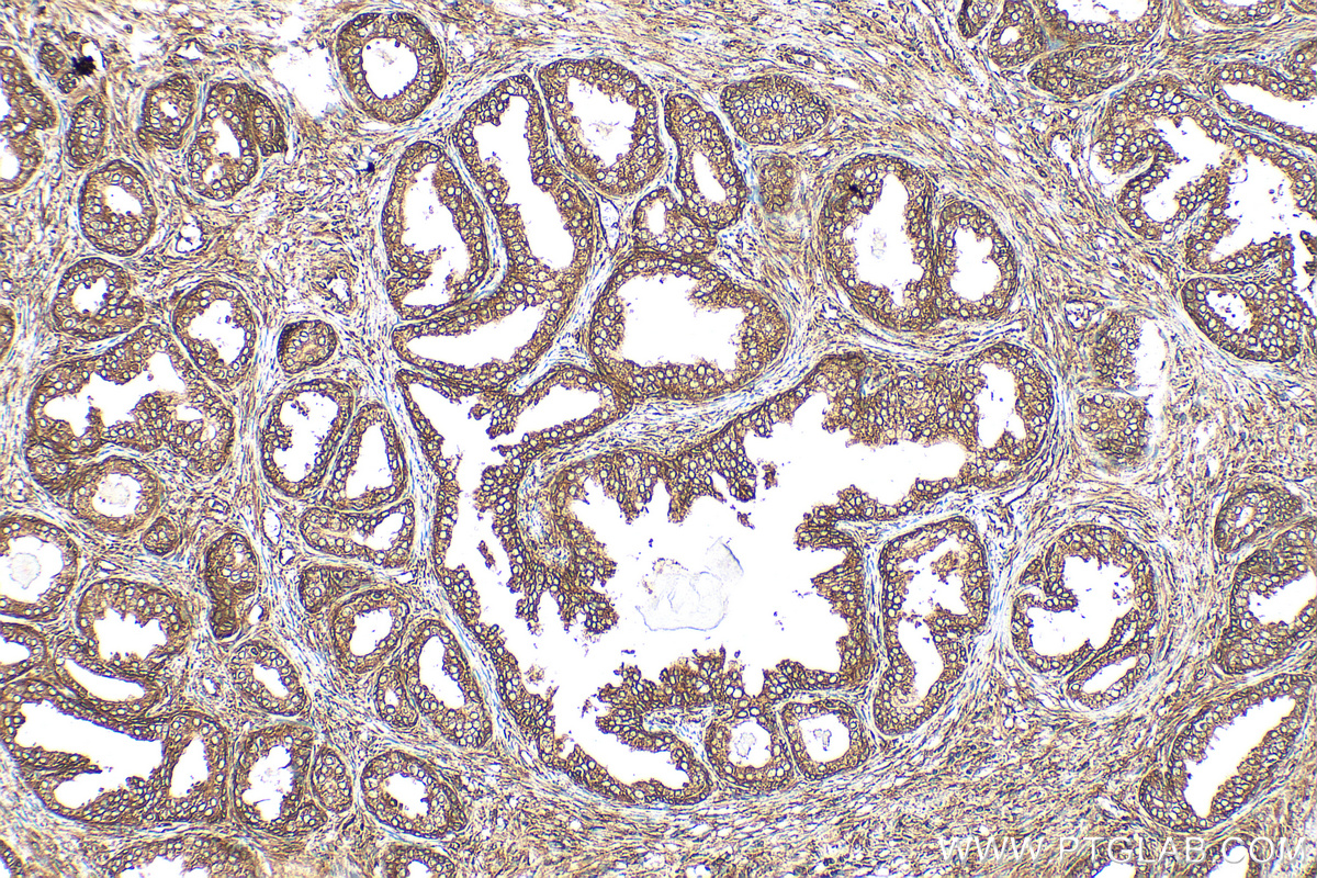 IHC staining of human prostate cancer using 15695-1-AP