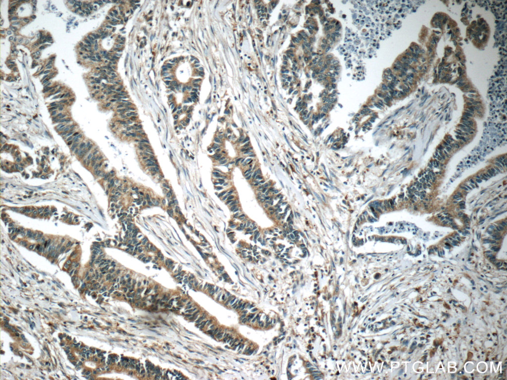 IHC staining of human pancreas cancer using 19974-1-AP