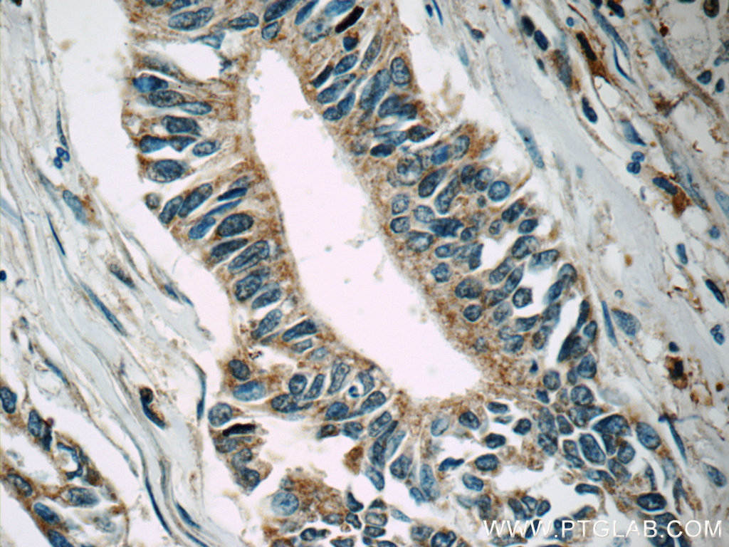 IHC staining of human pancreas cancer using 19974-1-AP