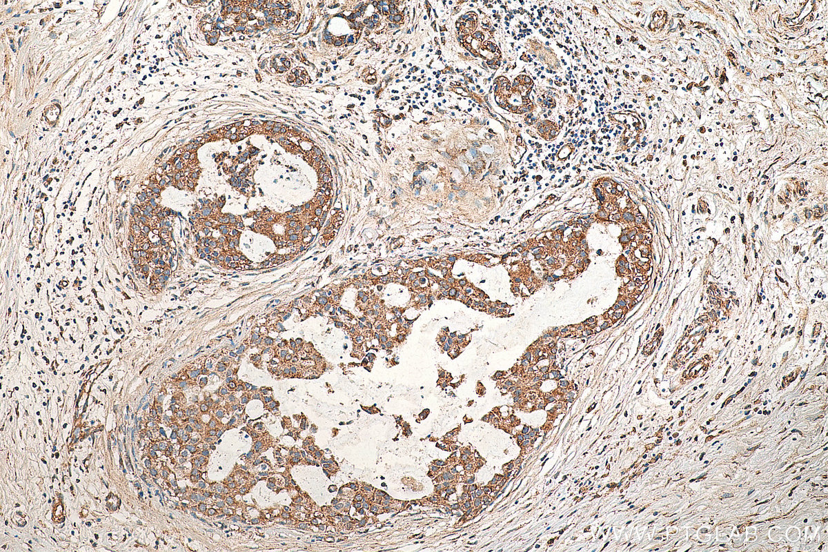 IHC staining of human breast cancer using 29265-1-AP