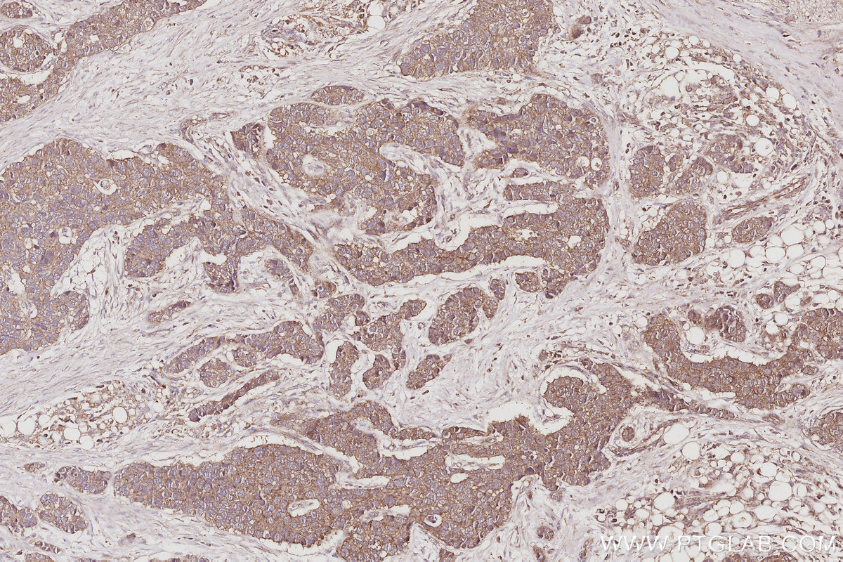 IHC staining of human stomach cancer using 29265-1-AP IHC staining of human stomach cancer using 29265-1-AP