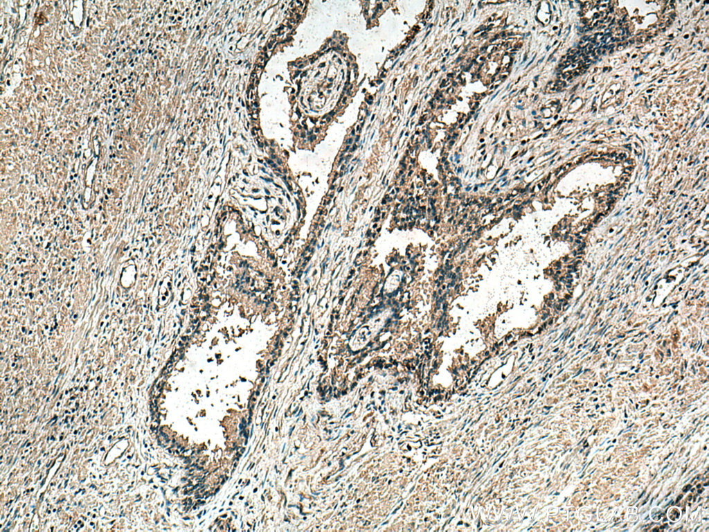 IHC staining of human prostate cancer using 67707-1-Ig (same clone as 67707-1-PBS)