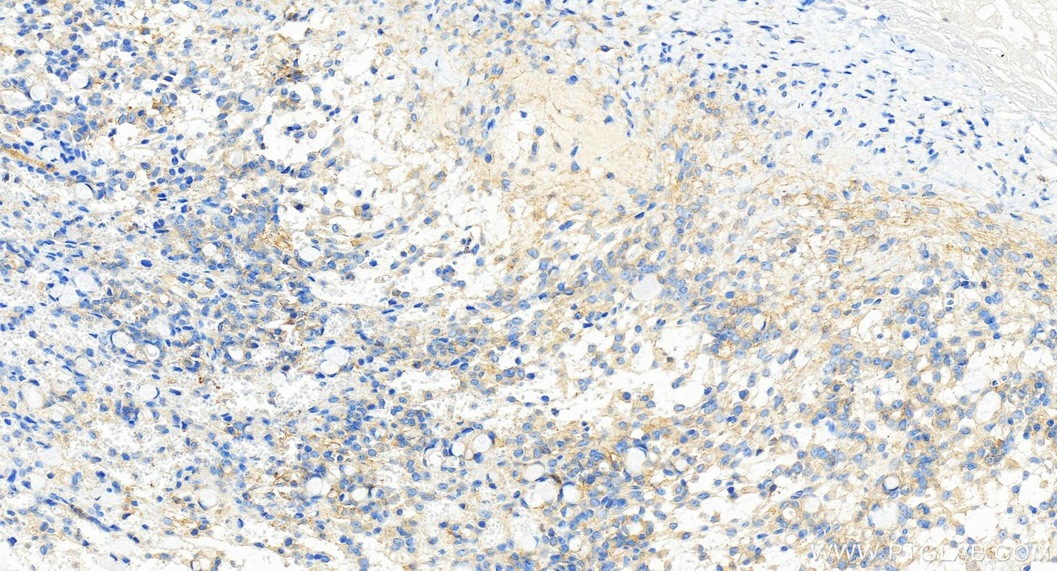IHC staining of human ovary cancer using 82948-5-RR