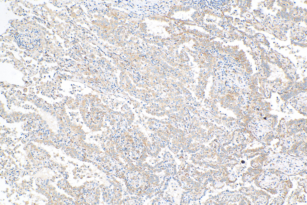 IHC staining of human lung cancer using 68271-1-Ig