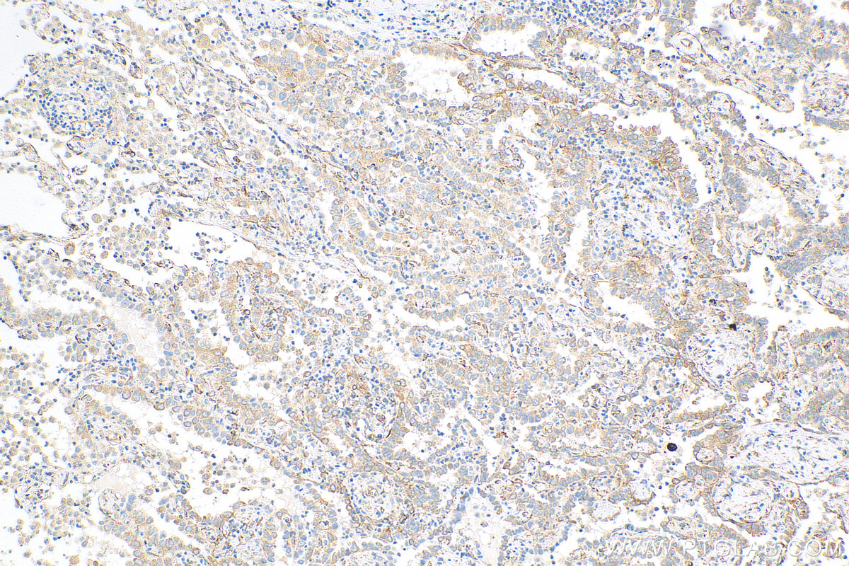 IHC staining of human lung cancer using 68271-1-Ig