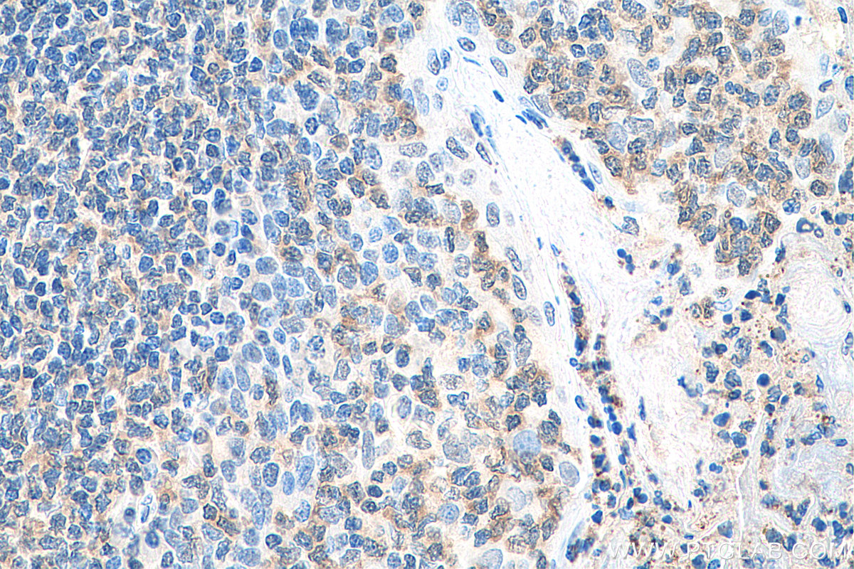 IHC staining of human tonsillitis using 23950-1-AP