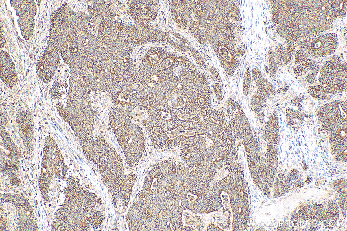 IHC staining of human colon cancer using 55244-1-AP