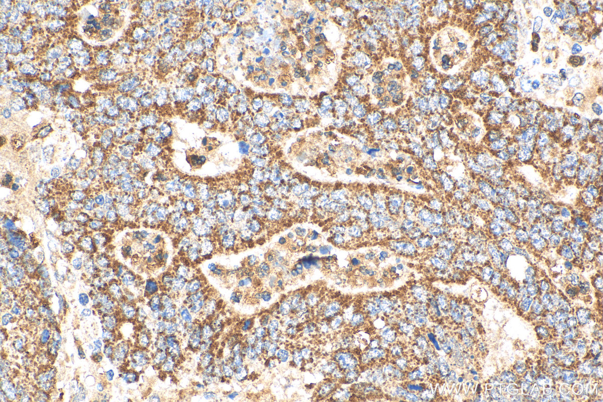 IHC staining of human colon cancer using 55244-1-AP